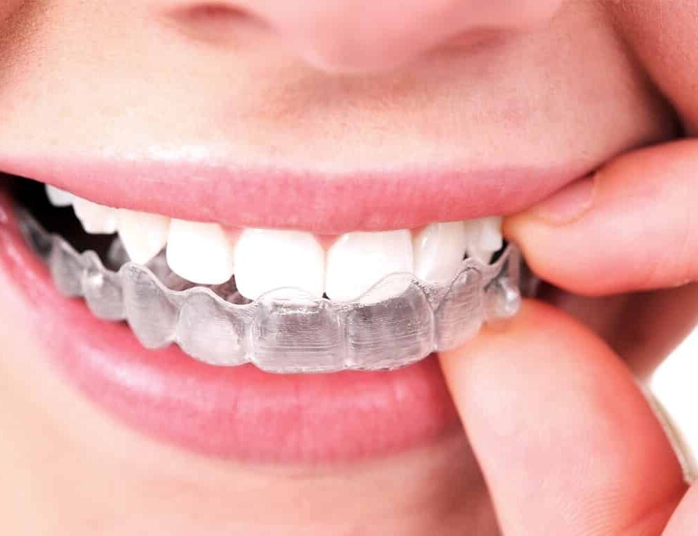invisalign-25